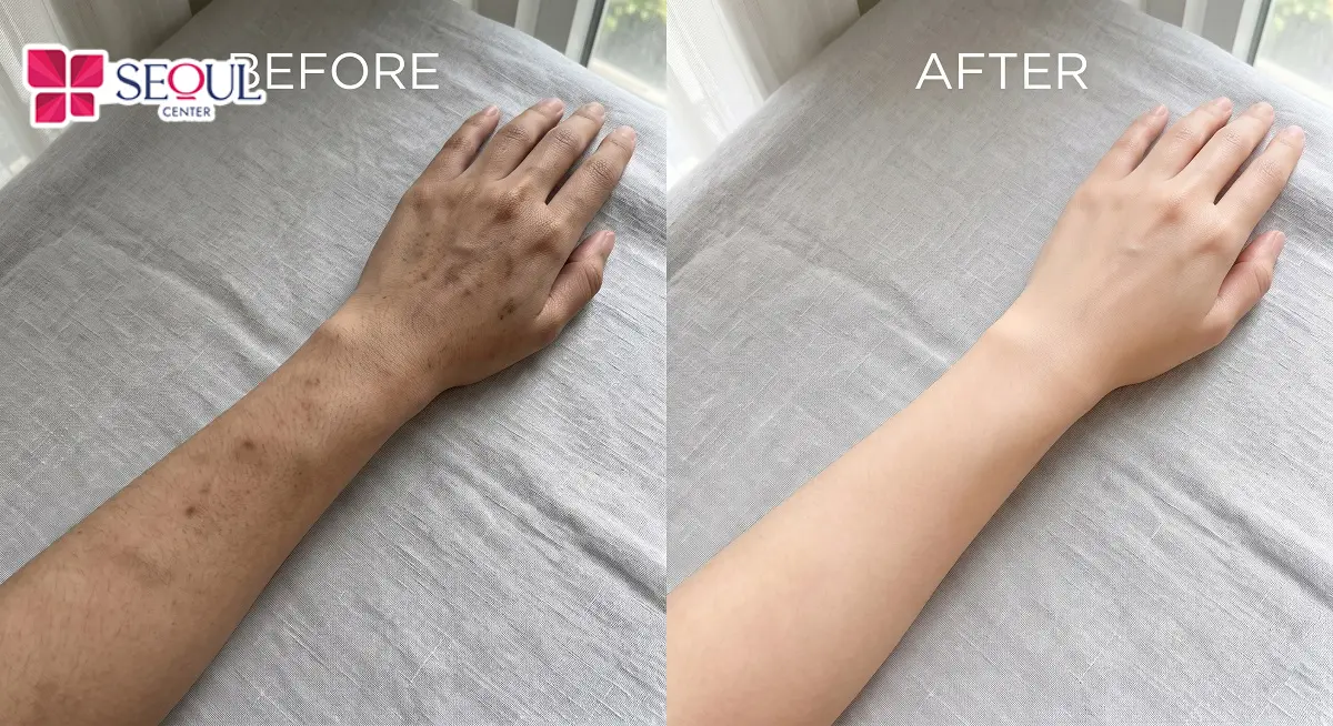 Da cải thiện rõ rệt sau liệu trình trị thâm tay Laser Fractional