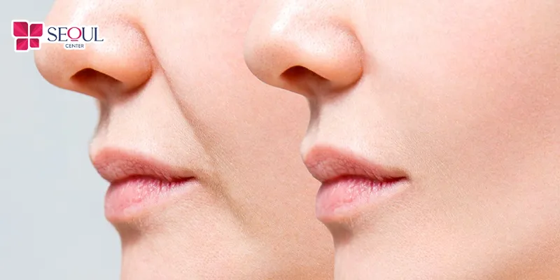 Tiêm filler rãnh cười giá bao nhiêu? Mức giá thường dao động từ 3-15 triệu
