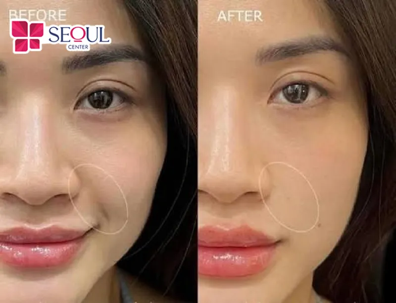 Tiêm filler rãnh cười hỗ trợ trẻ hóa diện mạo, không đau, không cần nghỉ dưỡng