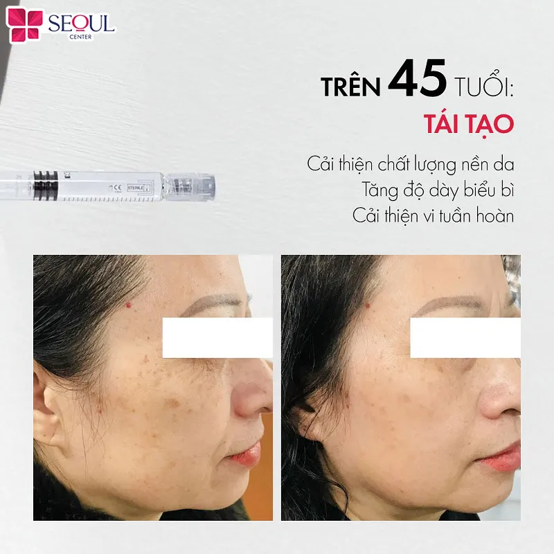 Liệu trình tiêm Trẻ Hóa Neo Doublyx Evo sở hữu nhiều ưu điểm vượt trội