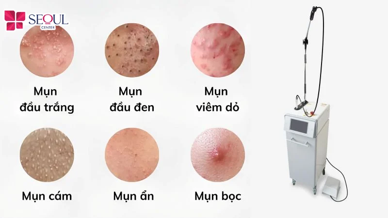 Mỗi tình trạng mụn được ứng dụng kỹ thuật chiếu bước sóng ánh sáng phù hợp