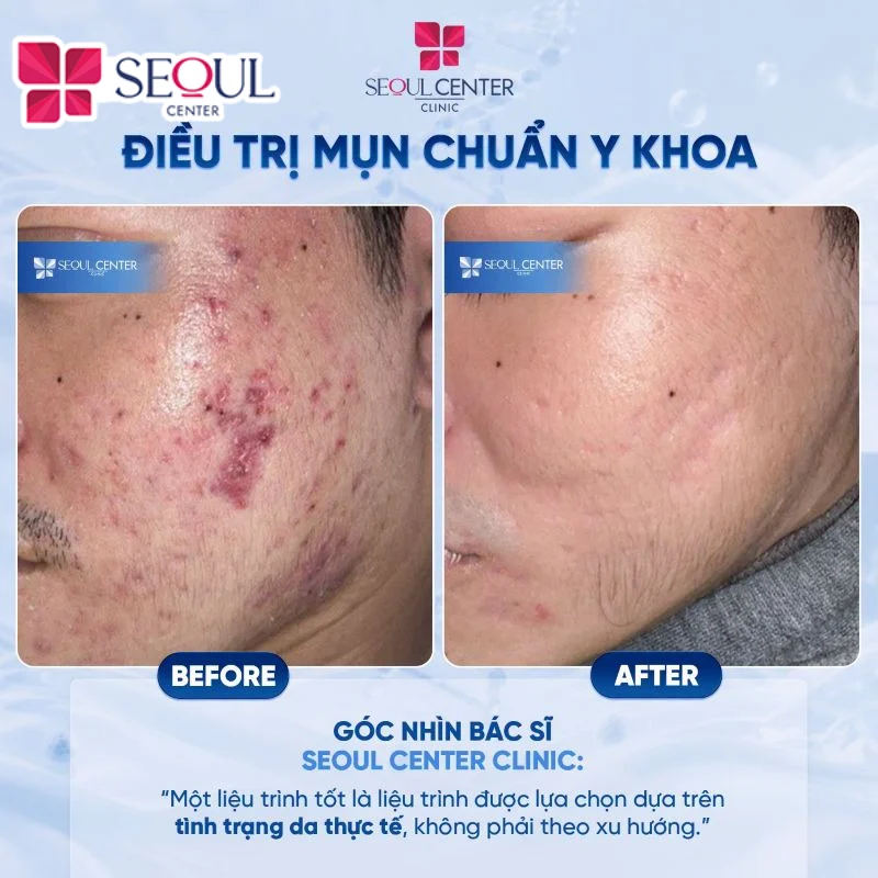 Chi phí điều trị mụn phụ thuộc vào tình trạng mụn thực tế của làn da