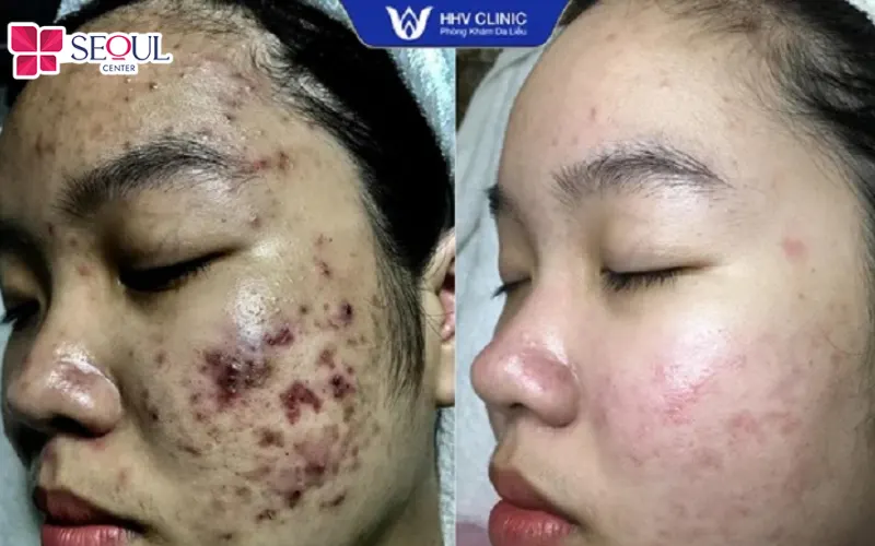 Hình ảnh khách hàng trước và sau khi điều trị mụn tại Phòng khám da liễu HHV CLINIC