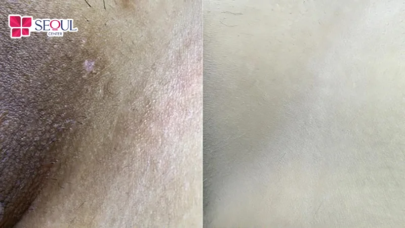 Dịch vụ trị thâm bẹn Laser Fractional sở hữu nhiều ưu điểm vượt trội giúp phụ nữ làm sáng da vùng bẹn theo chỉ định phù hợp với tình trạng da.