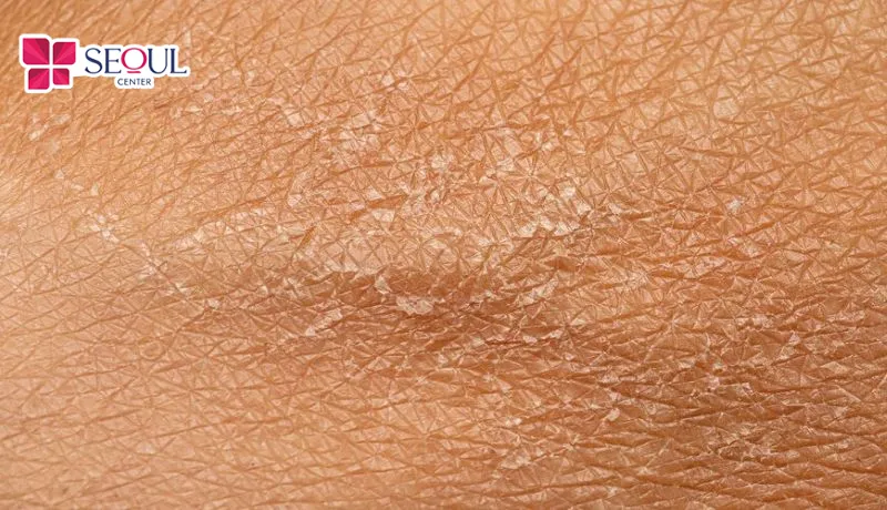Làn da vùng nhạy cảm bị thiếu ẩm dễ dẫn đến cảm giác châm chích ngứa ngáy