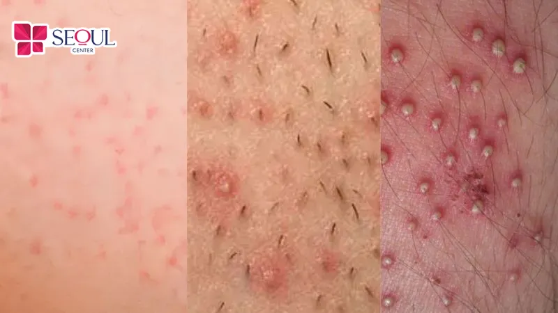 Thời gian dịu ngứa phụ thuộc vào tình trạng da và chế độ chăm sóc