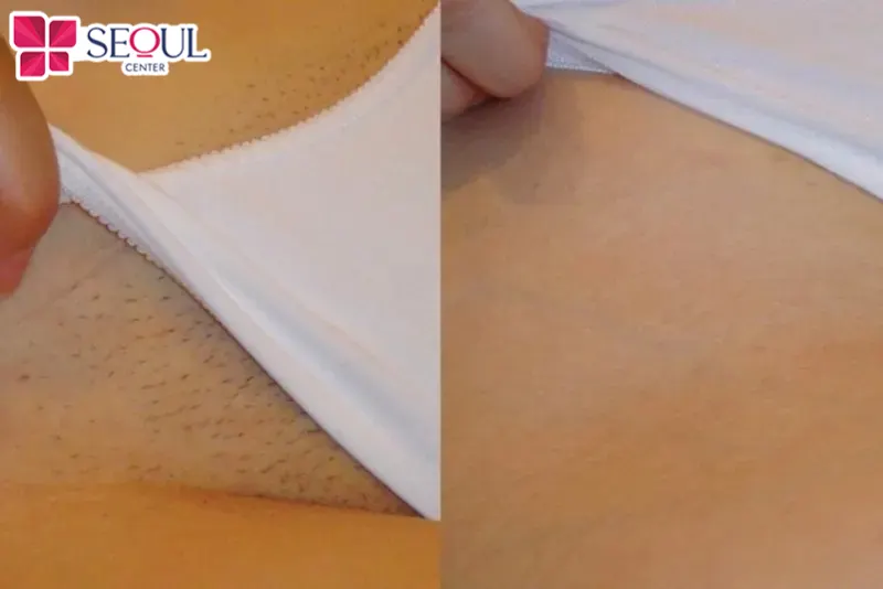 Vùng bikini trở nên mịn màng, trắng sáng hơn khi triệt lông tại Thẩm mỹ viện Seoul Center