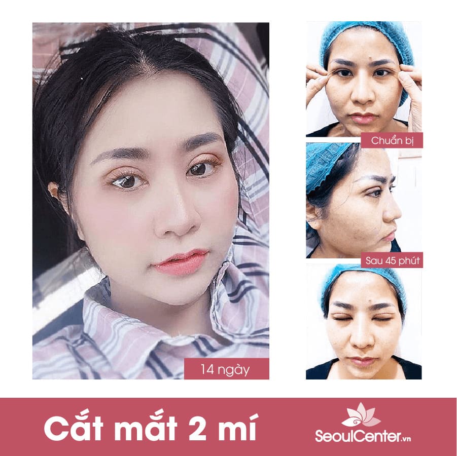 Khách hàng T.K.C đã thành công khắc phục mắt 1 mí kém duyên
