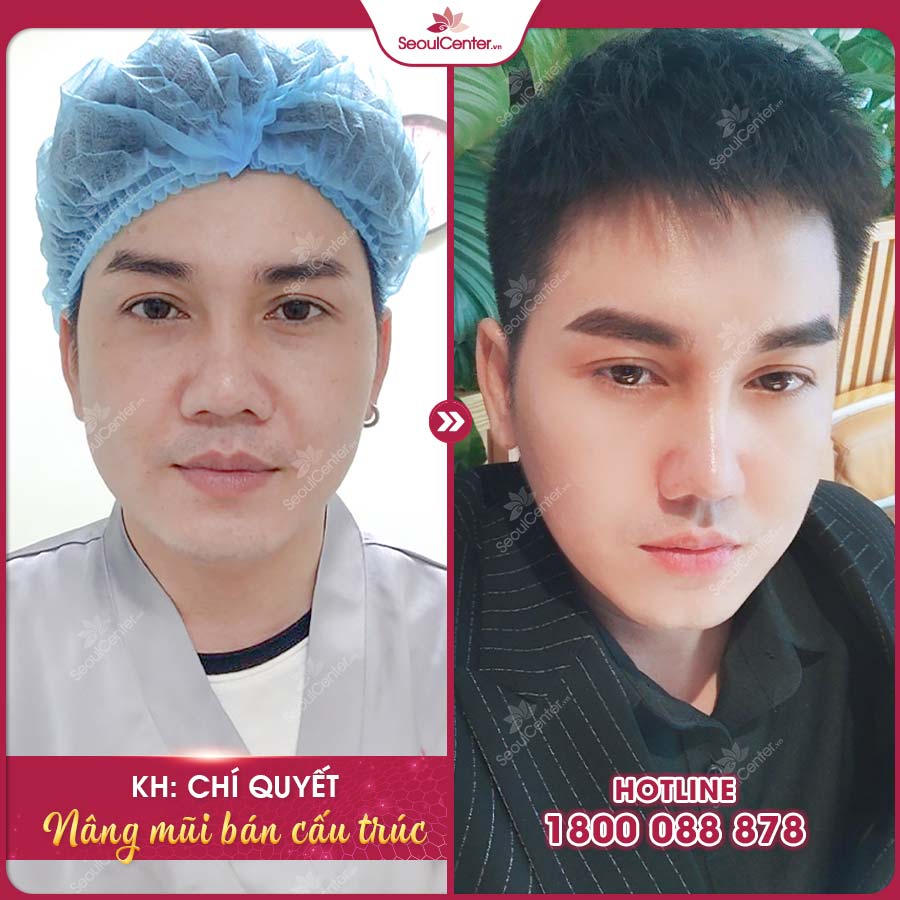 Chí Quyết - Tôi cảm thấy mình thay đổi hoàn toàn sau nâng mũi