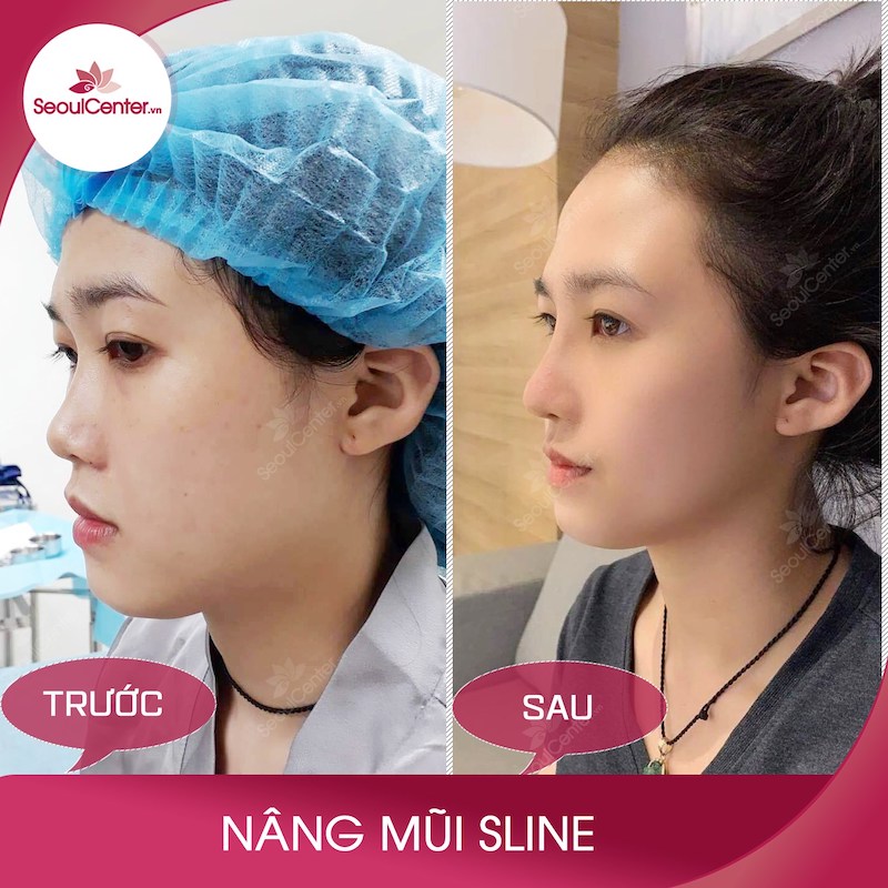 Mũi vào Form đẹp sau khoảng 1 tháng nâng mũi