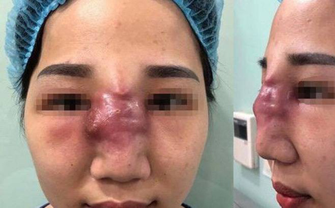 Vùng tiêm filler bị sưng tấy, nhiễm trùng, u cục