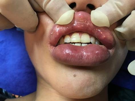 Filler bị vón cục, u sần sau khi tiêm