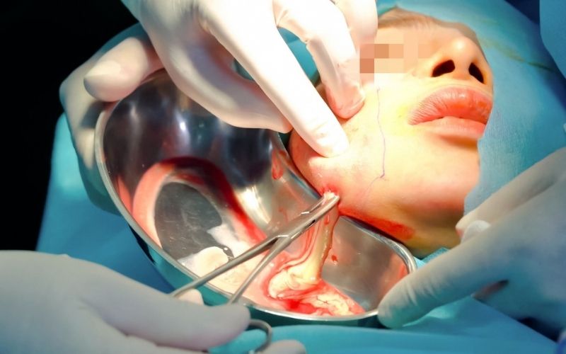 Cách xử lý sau khi tiêm filler bị áp xe, tụ mủ
