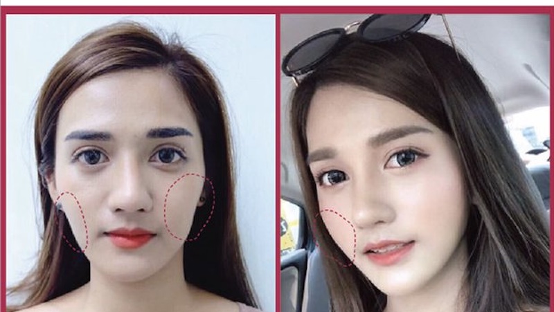 Kết quả tiêm filler tại Seoul Center duy trì lâu dài do sử dụng filler chất lượng