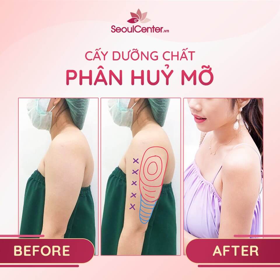 Bắp tay thon thả ngay sau khi thực hiện phương pháp cấy dưỡng chất phân hủy mỡ