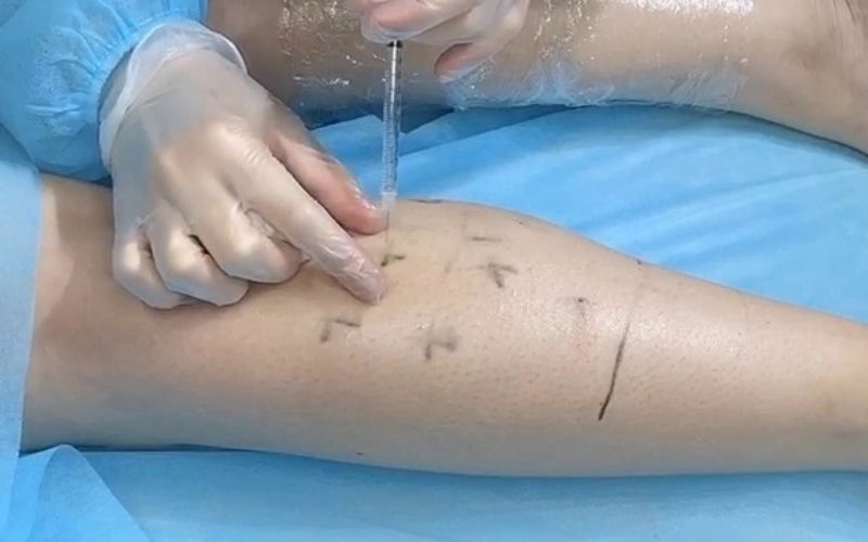 Các công nghệ giảm mỡ hiện đại “xóa tan” lớp mỡ nhanh bất ngờ