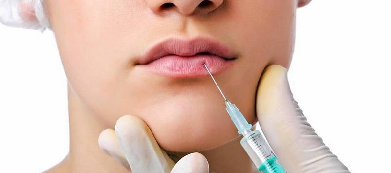 Tiêm filler giúp tạo hình môi trái tim