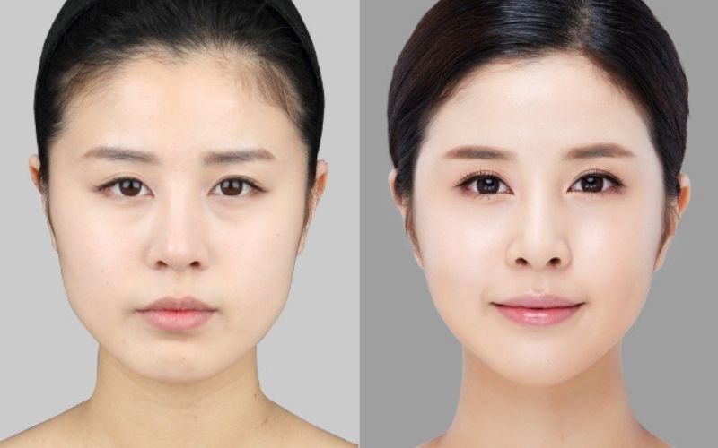 Kết quả tạo dáng cằm mới đẹp, thon gọn chuẩn V-Line bằng hợp chất filler Kết quả tạo dáng cằm mới đẹp, thon gọn chuẩn V-Line bằng hợp chất filler