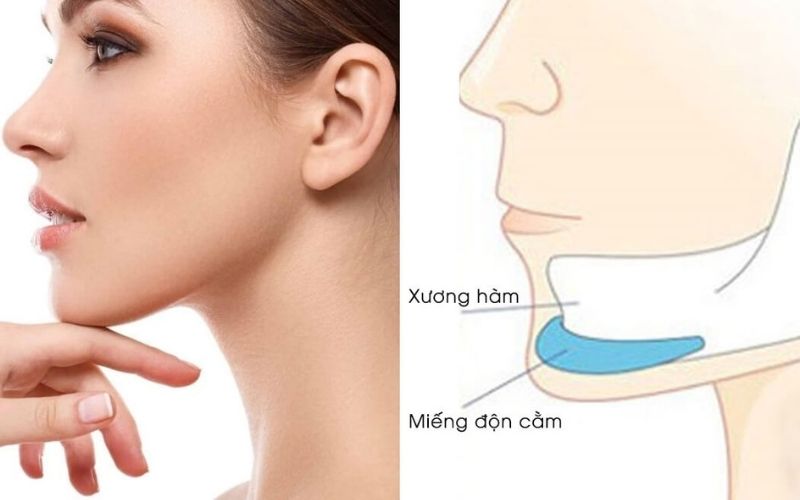 Phẫu thuật độn cằm giúp cằm dài ra Phẫu thuật độn cằm giúp cằm dài ra