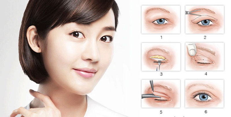 Cắt mí mắt hoàn toàn không gây ảnh hưởng đến thị lực