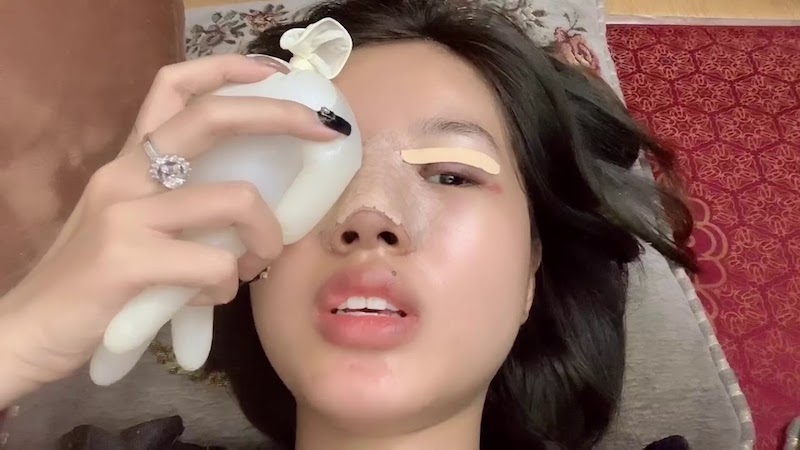 Bạn có thể giảm đau sau khi cắt mí mắt bằng cách chườm đá