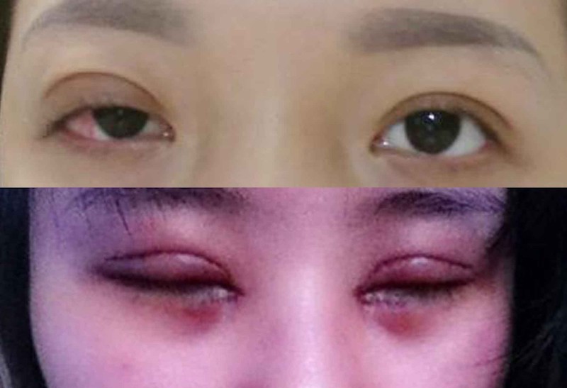 Mí mắt bị tổn thương làm giảm hiệu quả làm đẹp