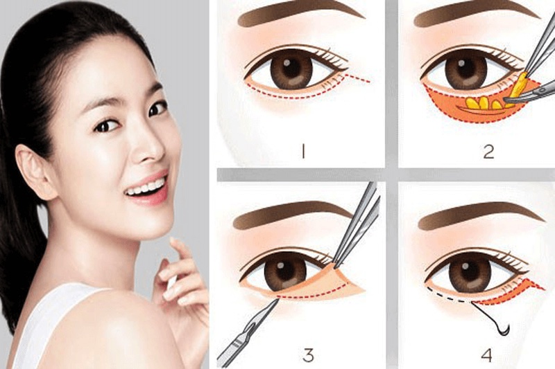 Kỹ thuật cắt mí dưới