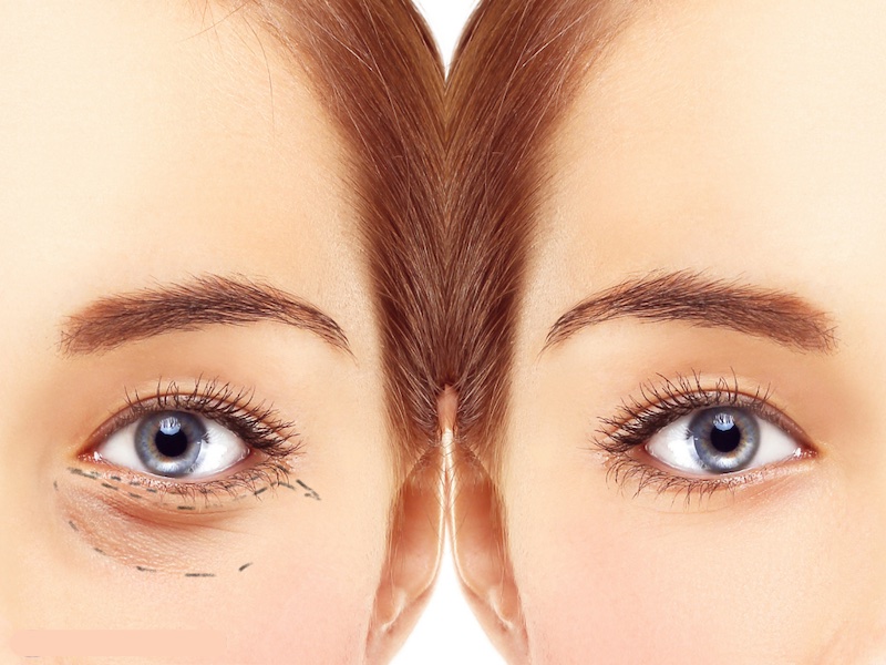Cắt mí dưới giúp bạn có được đôi mắt trẻ trung
