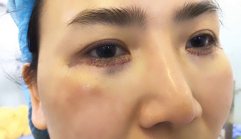 Quy trình cắt mí dưới