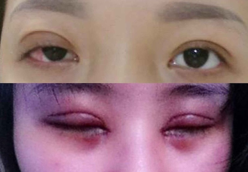 Tay nghề bác sĩ kém có thể gây tổn thương mí mắt sau khi phẫu thuật