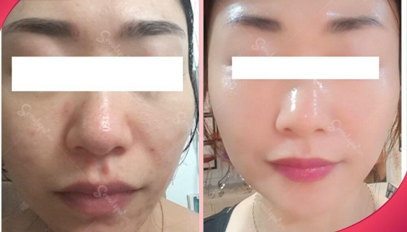 Hình ảnh làn da của khách hàng đã trở nên căng mọng, sáng mịn hơn và cũng không còn những vết thâm trên da khi thực hiện cấy tảo xoắn tại Seoul Center