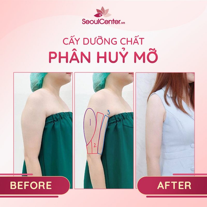 Cấy dưỡng chất phân huỷ mỡ bắp tay