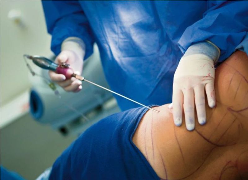 Lựa chọn địa chỉ thẩm mỹ uy tín để đảm bảo an toàn khi hút mỡ