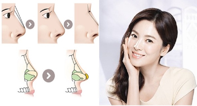 Nâng mũi được đánh giá là tiểu phẫu, không ảnh hưởng đến sức khỏe cơ thể