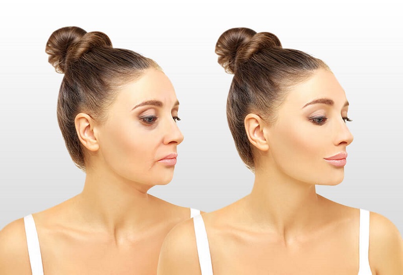 Tiêm filler đem lại những chuyển biến rõ rệt cho vùng được tiêm - Có nên tiêm filler mặt