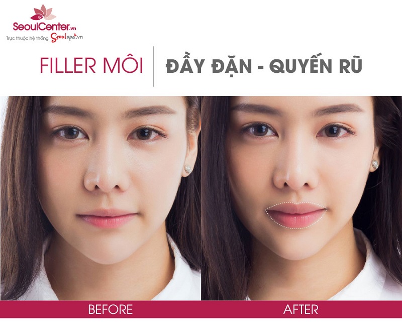 Kết quả tiêm filler tại Seoul Center - Có nên tiêm filler mặt