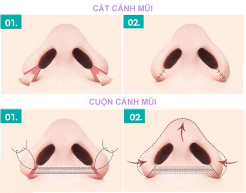 Cuộn cánh mũi và cắt cánh mũi là 2 phương pháp thon gọn cánh mũi rất hiệu quả