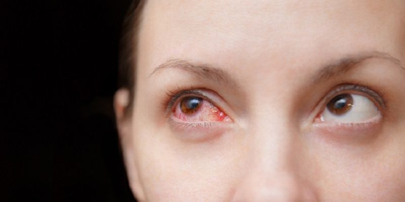 Triệu chứng đau mắt đỏ rất dễ nhận diện bằng mắt