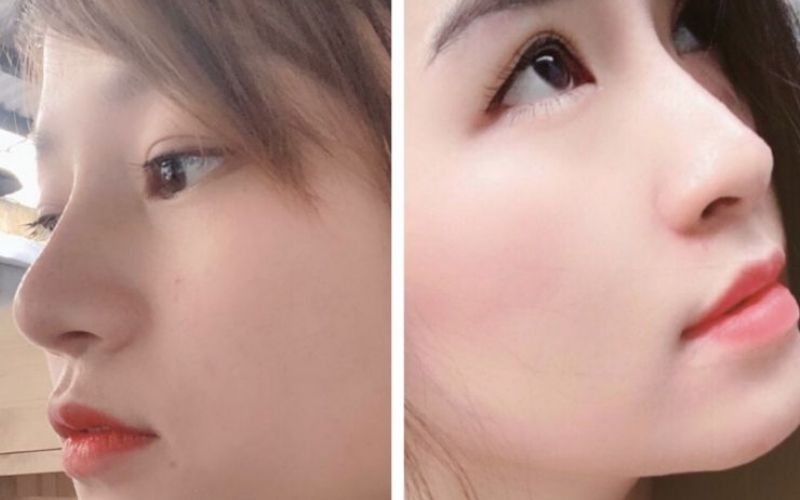 Filler giúp cho chiếc mũi cao tự nhiên mà không cần phẫu thuật