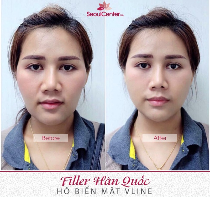 Ca tiêm filler Hàn Quốc cho mặt thành công tại Seoul Center