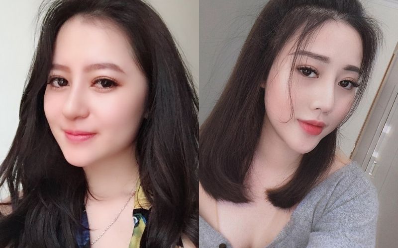 Form mũi chuẩn dáng mà không cần phẫu thuật