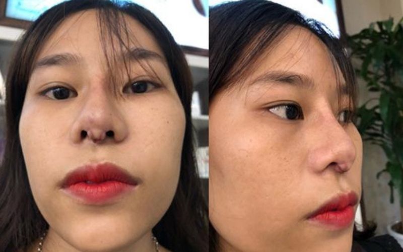 Không nên tự ý mua filler giá rẻ về tự tiêm chích tiềm ẩn nhiều rủi ro