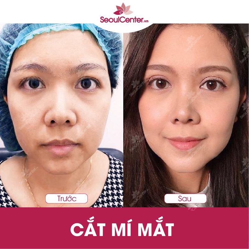 Hình ảnh trước và sau khi cắt mí