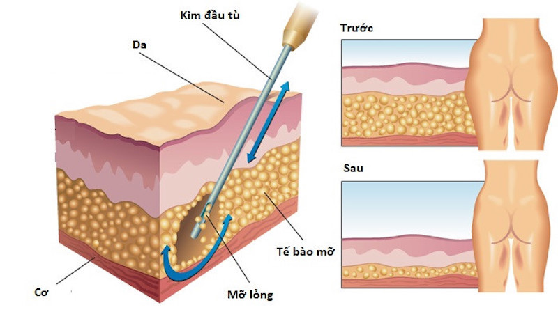 Hút mỡ bằng công nghệ hiện đại