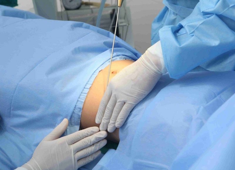 Quy trình hút mỡ hoàn toàn không đau và đảm bảo an toàn tuyệt đối