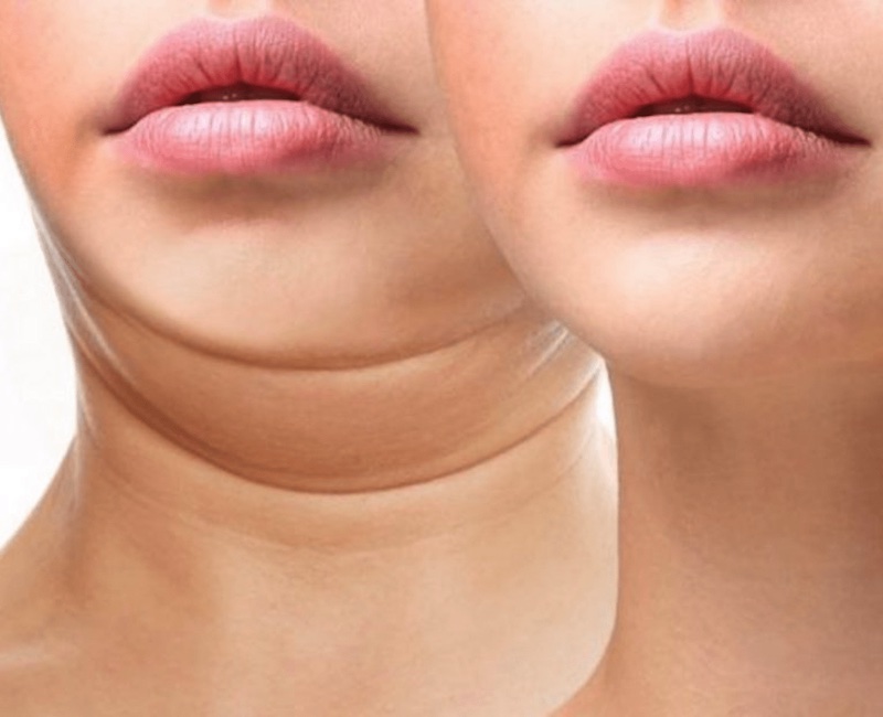 Hút mỡ mặt sẽ khá nguy hiểm nếu không được thực hiện đúng kỹ thuật