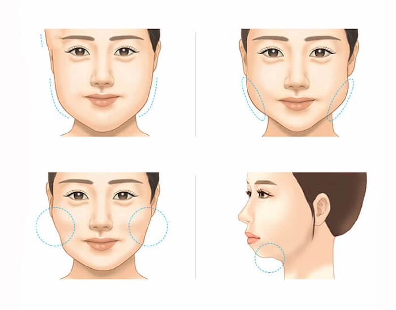 Lựa chọn cơ sở thẩm mỹ có công nghệ hút mỡ hiện đại