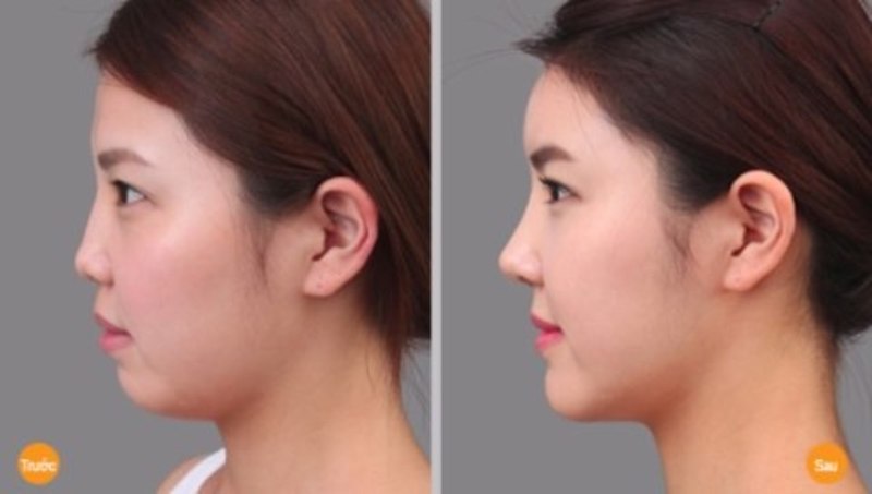 Hình ảnh khách hàng sau khi hút mỡ mặt