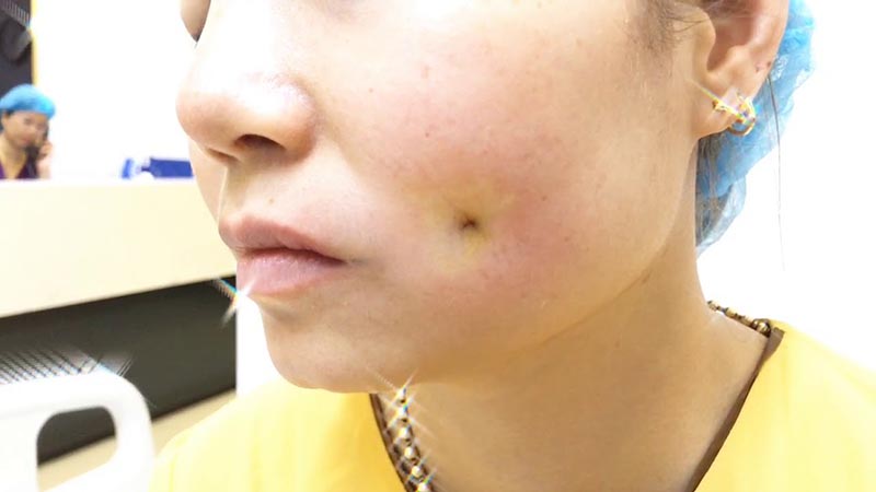 Làm má lúm đồng tiền hoàn toàn không đau bởi bạn sẽ được gây tê Làm má lúm đồng tiền hoàn toàn không đau bởi bạn sẽ được gây tê