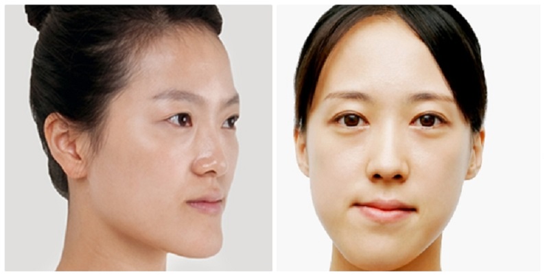 Tiêm botox không khéo léo có thể gây tình trạng bị lệch hàm